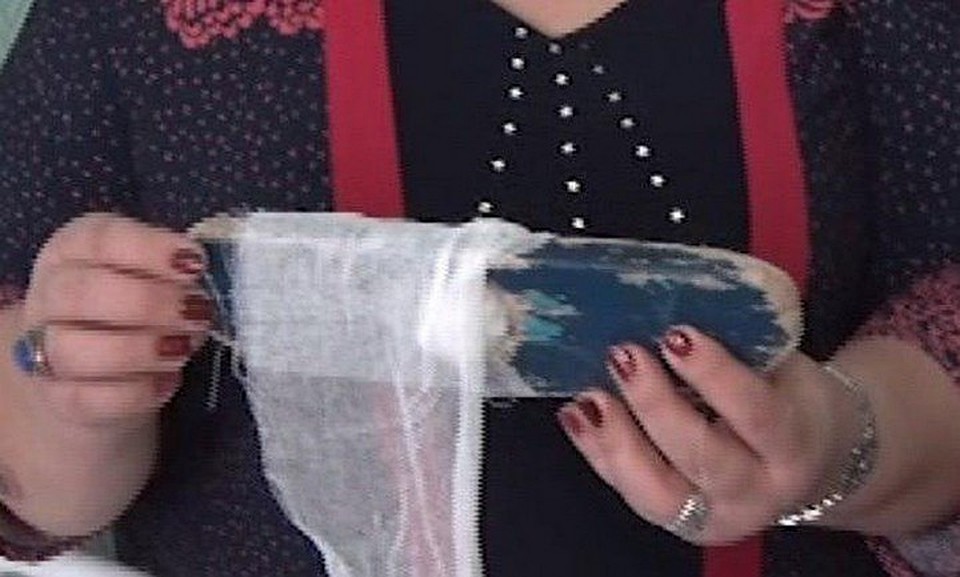 В Уфе скончалась бабушка, которой сделали шину из старой швабры