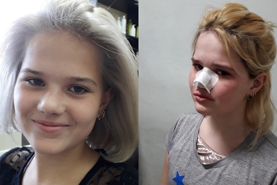 Ева сейчас в больнице. По словам мамы, у нее закрытая черепно-мозговая травма и смещение перегородки носа.