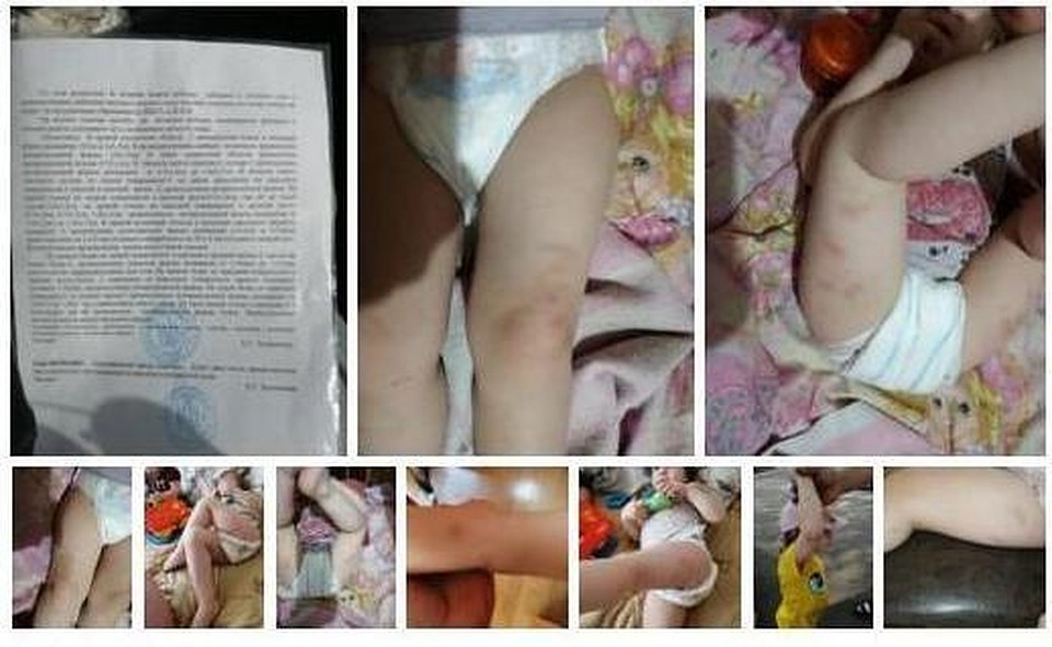 В Омске родители обвиняют няню садика в синяках на теле ребенка