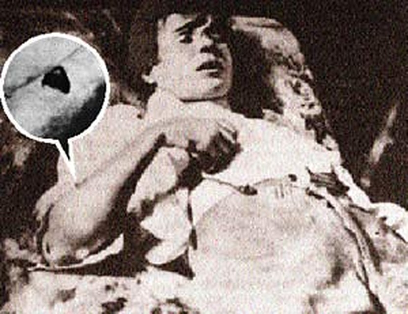 Труп Сергея Александровича на кушетке в номере гостиницы. Правая рука согнута. На предплечье - рана с лоскутом кожи.
