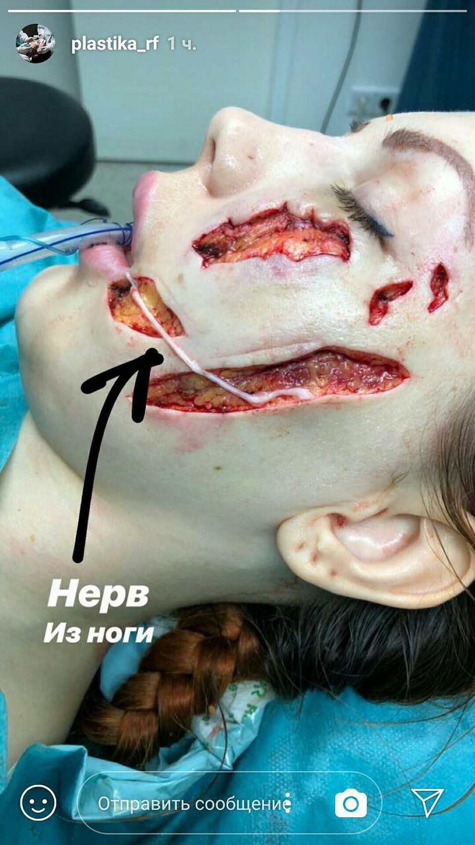 Ирине сделали сложную реконструкцию лицевого нерва, который взяли с ноги.