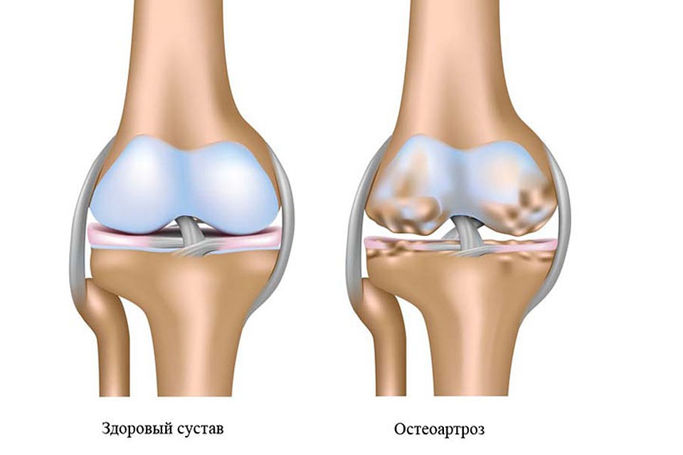 Что происходит в больных суставах