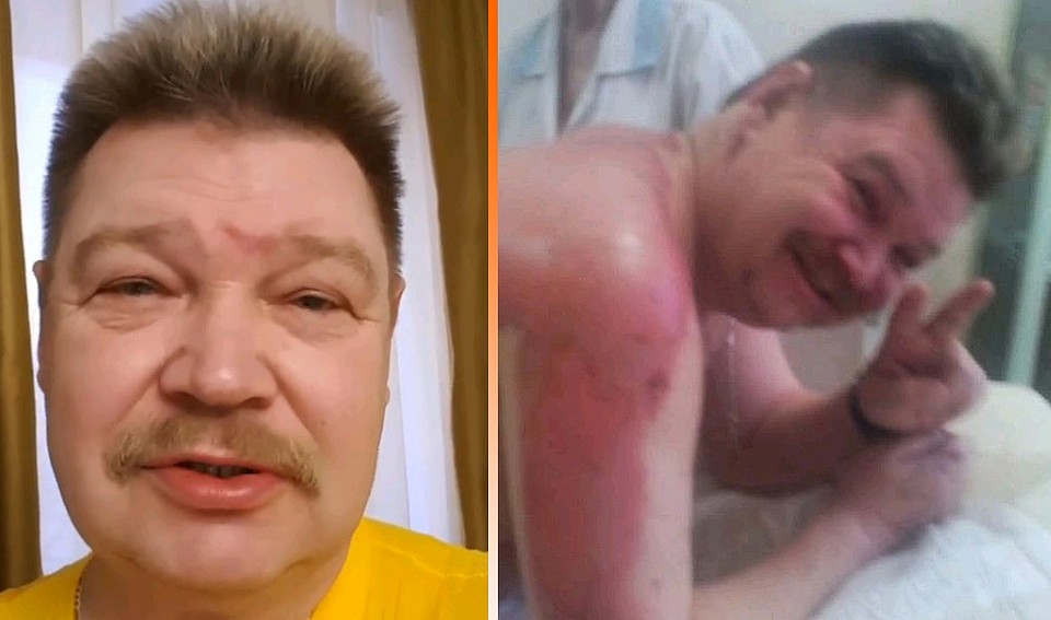 Несмотря на ожоги и утрату имущества, Николай Бандурин старается не унывать и планирует новые концерты. Фото: Личная страничка героя публикации в соцсети