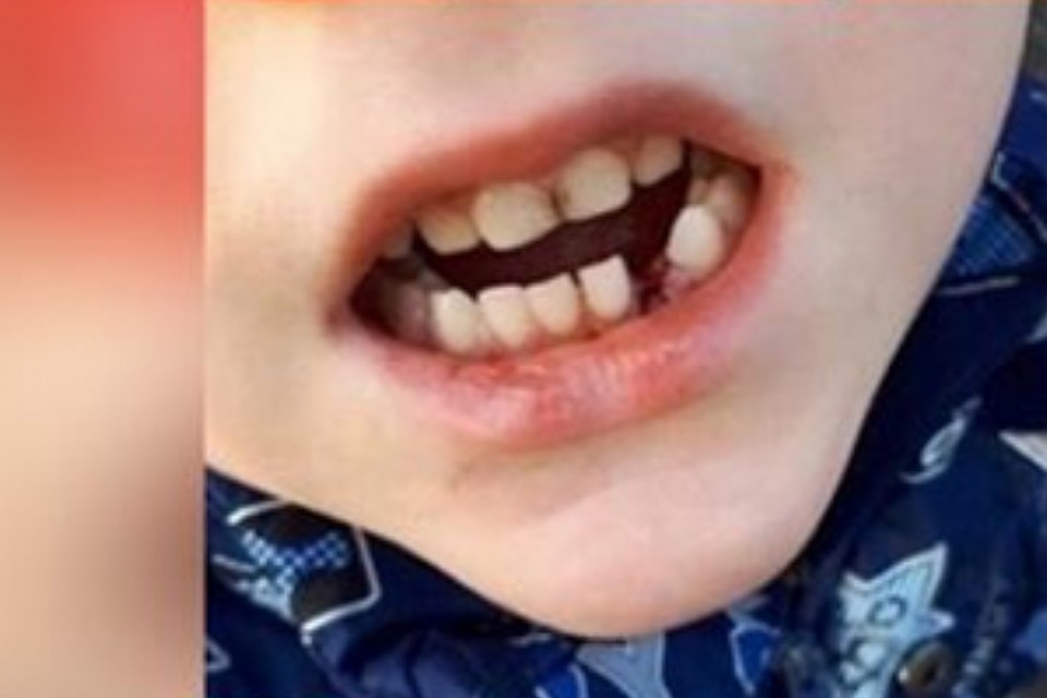 Зубы мальчика после избиения Фото: СОЦСЕТИ