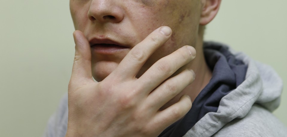 Лечение перелома челюсти в домашних условиях: правила 3 Лечение перелома челюсти в домашних условиях: правила 18